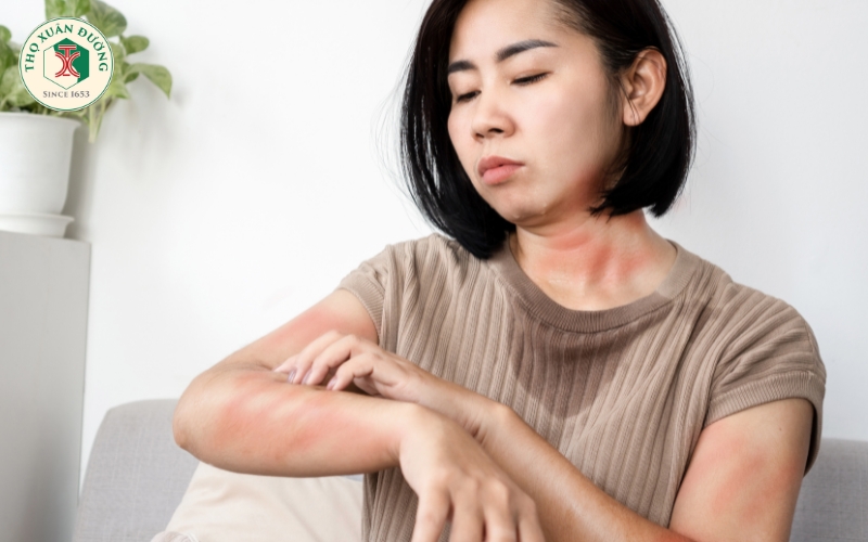 Hiểu đúng về mề đay